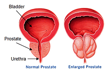 prostate natural